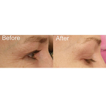 Full Face LED Light Therapy System