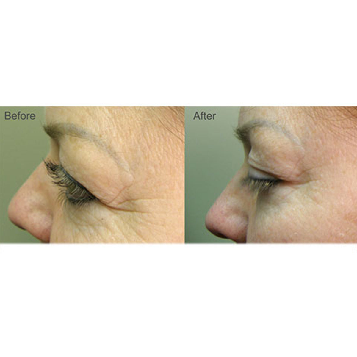 Full Face LED Light Therapy System