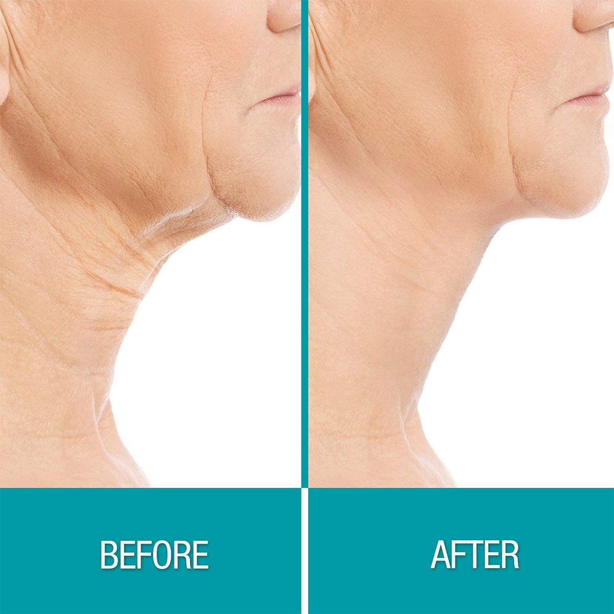 Chin & Neck Cooling Sculpt System