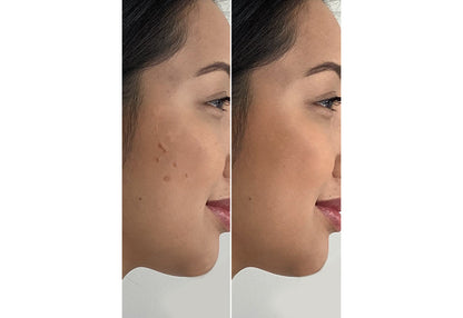 4-in-1 Microdermabrasion Kit