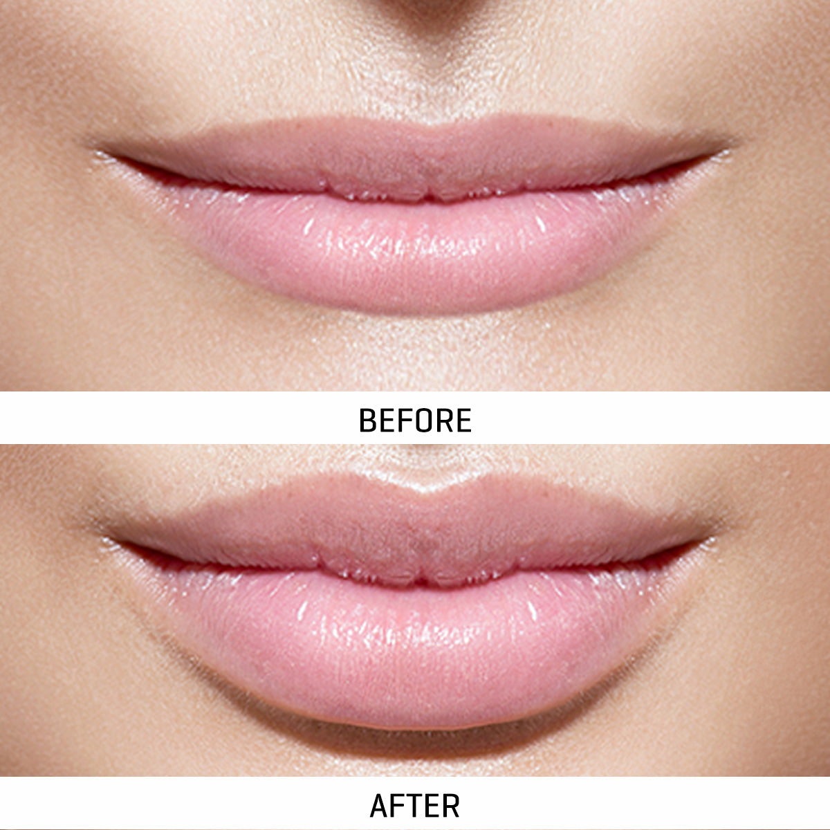 LED Lip Therapy Device