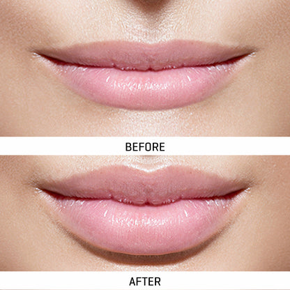 LED Lip Therapy Device