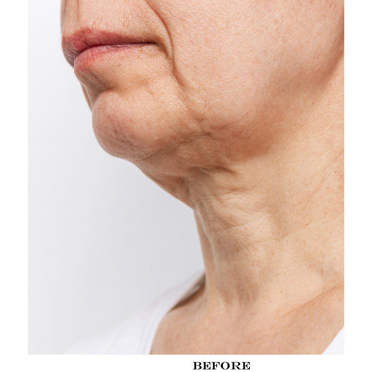 Neck Smoothing Therapy Device