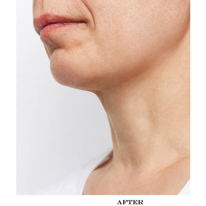 Neck Smoothing Therapy Device
