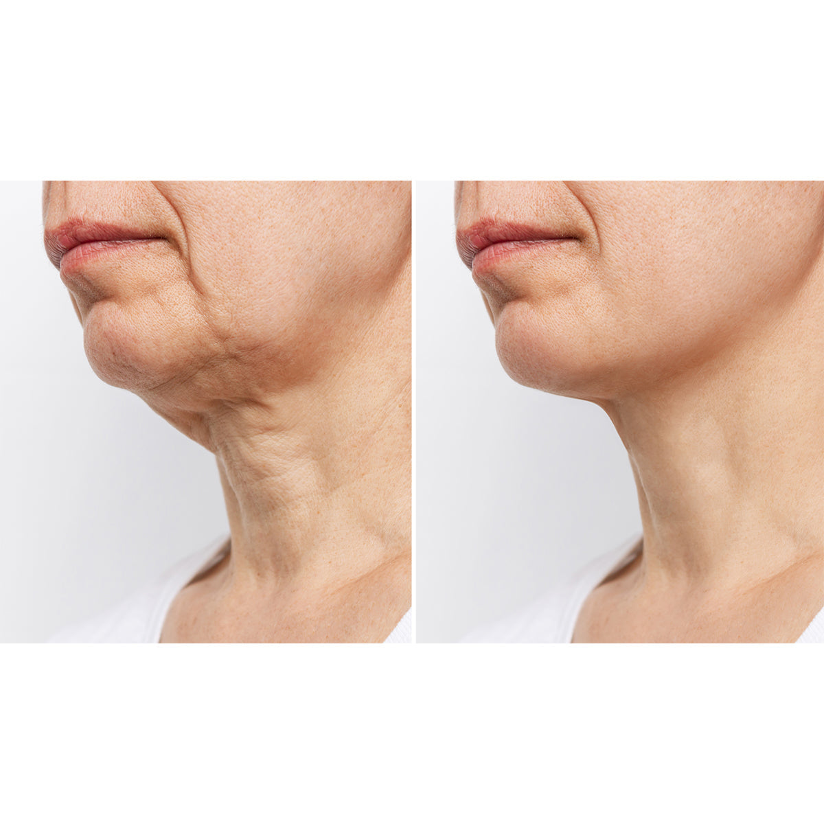 Neck Smoothing Therapy Device