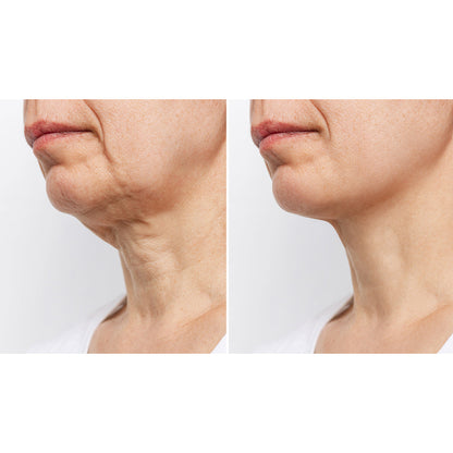 Neck Smoothing Therapy Device
