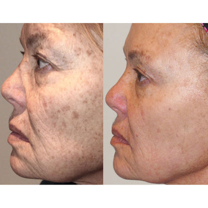 Blemish & Hair Removal Device