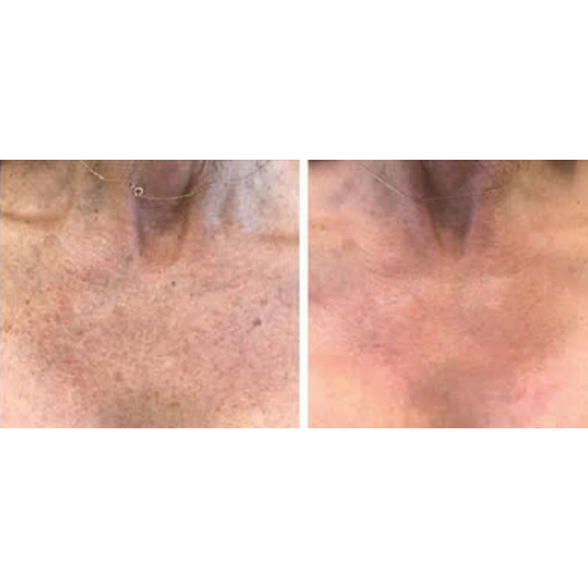 Blemish & Hair Removal Device