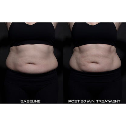 5-in-1 Body Contouring Device