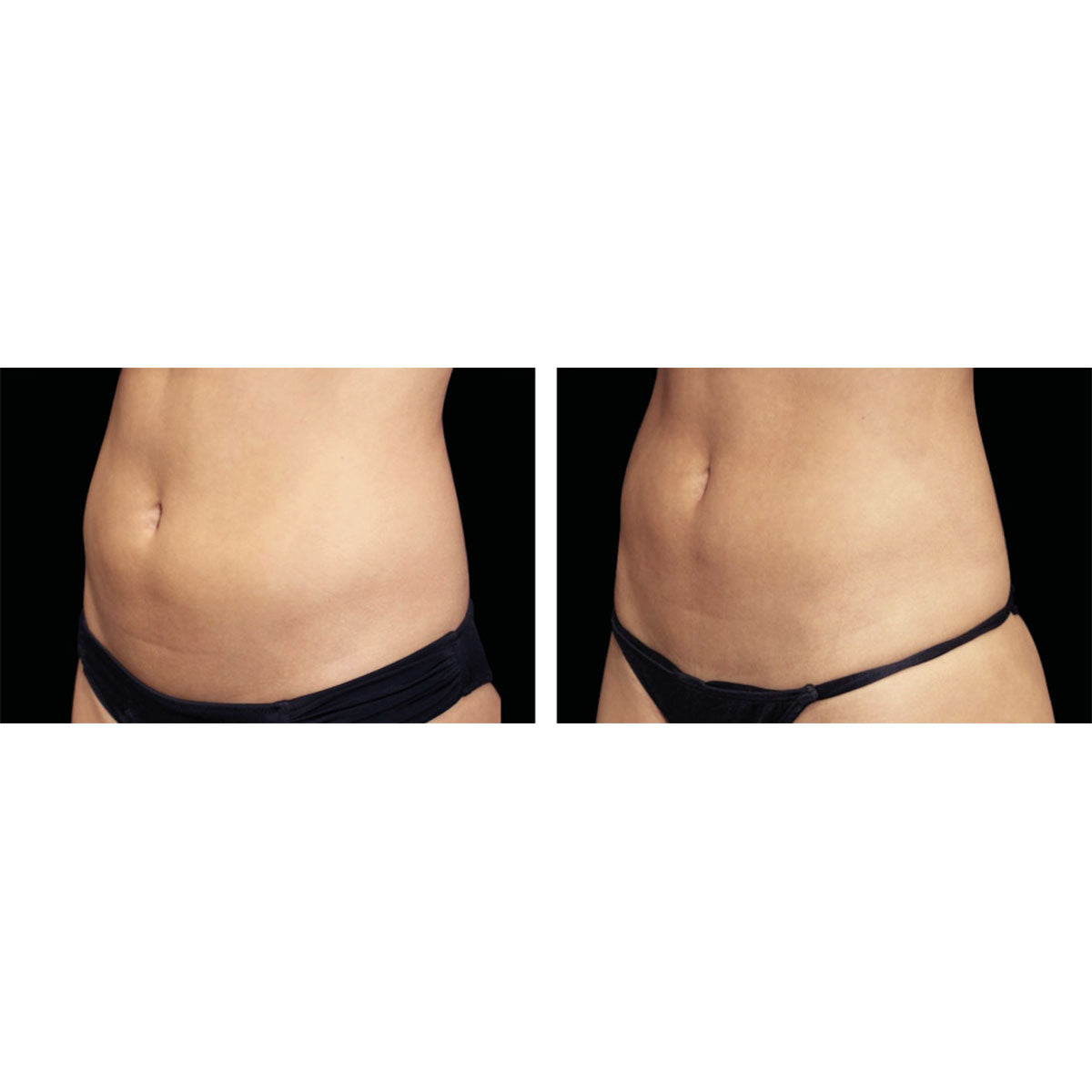 5-in-1 Body Contouring Device