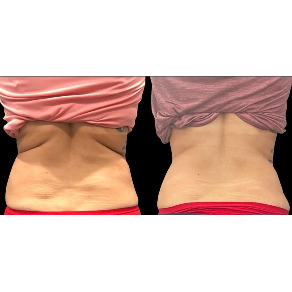 5-in-1 Body Sculpting Device
